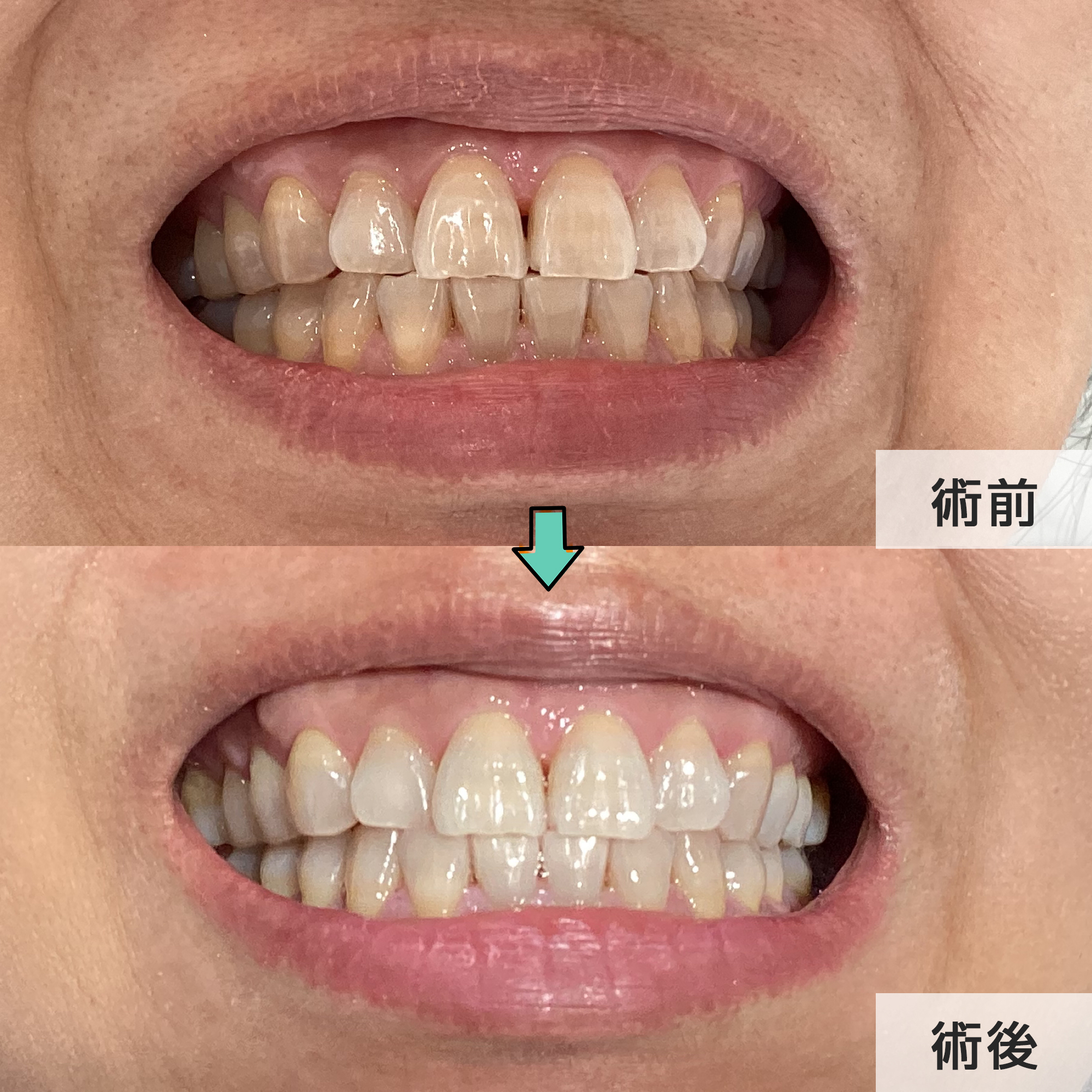 ホワイトニング